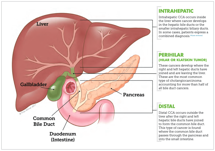 Cholangiocarcinoma – Bile Duct Cancer Sub types What are the different types of cholangiocarcinoma - a cancer of the bile ducts